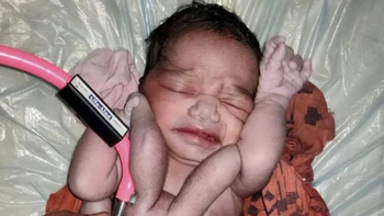 Nació un bebé con cuatro brazos y cuatro piernas, y dicen que es El elegido de Dios