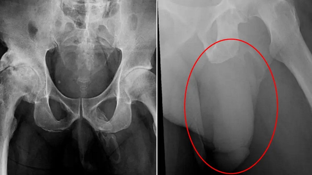 Las imágenes radiográficas que dan cuenta de la formación ósea en el pene del hombre (Foto: Reviews in Urology).