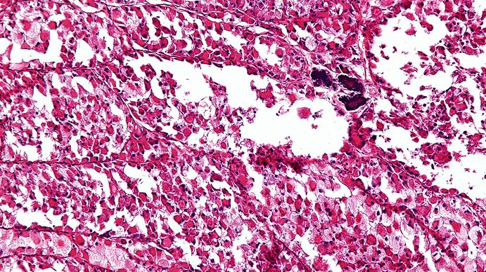 En el Día Internacional del Sarcoma, la radiografía de un cáncer que tiene más de 150 variedades