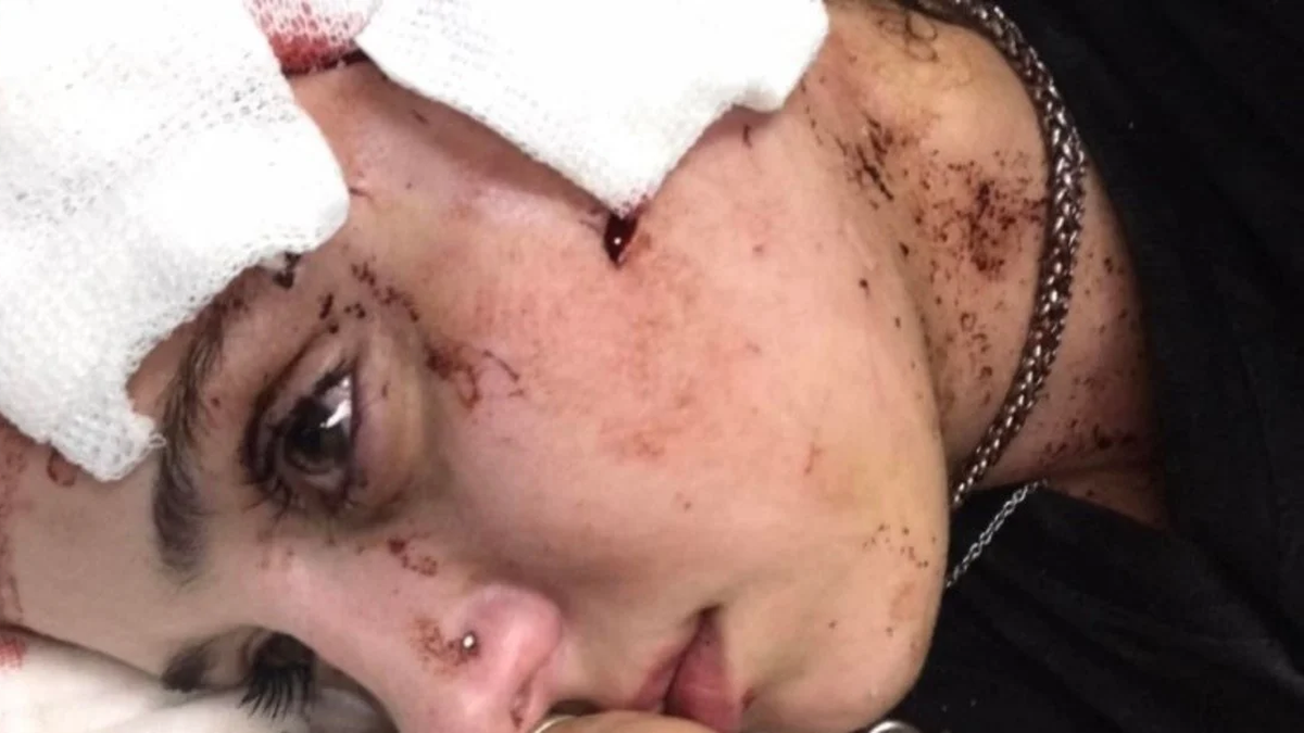 Le partió un vaso de vidrio en la cara a una moza y no irá preso