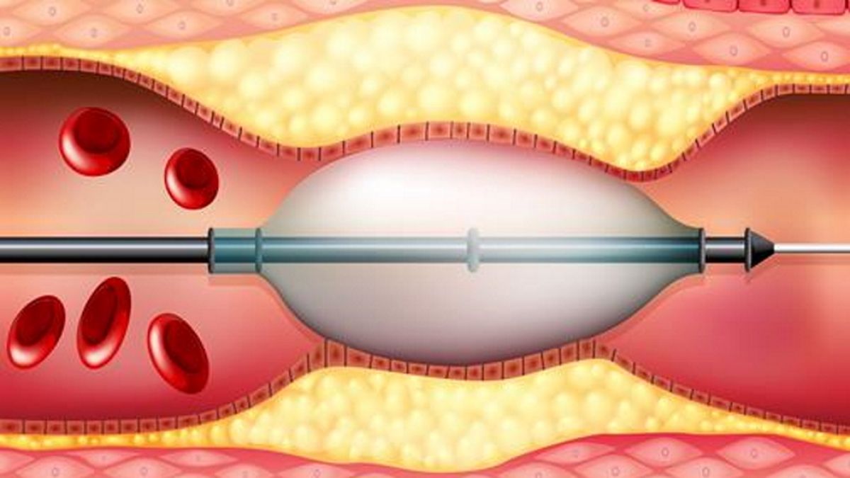 Stent coronario
