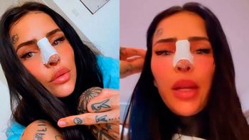Cande Tinelli mostró cómo le quedó la nariz tras pasar por el quirófano