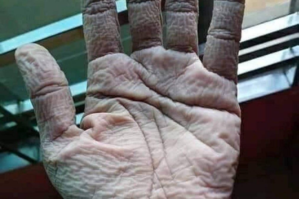 Foto: así le quedó la mano a un medico tras usar los guantes protectores contra el coronavirus