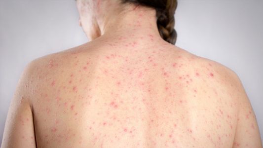 Apareció un posible caso de sarampión en la Ciudad: ¿cuáles son los síntomas de la enfermedad y quiénes deben vacunarse?