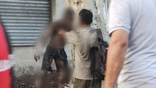 Quiso robar cables de luz y quedó con el 90% del cuerpo quemado