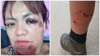 Fue atacada por una jauría mientras paseaba en bicicleta y relató su calvario: Apenas podía respirar