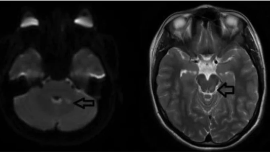 Introdujo un corcho en su vagina durante un juego sexual y lo tuvo durante 3 años: le salvaron la vida