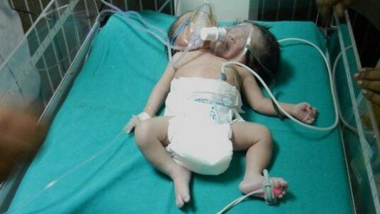 Una pareja que esperaba mellizos dio a luz un bebé con dos cabezas