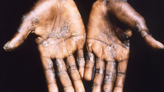 Viruela del mono: el Reino Unido armó una guía de recomendaciones para evitar la expansión del brote