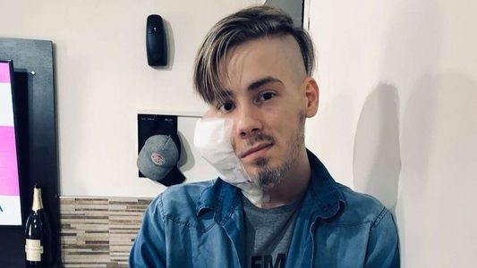 Murió Sebastián Amurín, el joven que tenía un extraño tumor en su cara y que conmovió por su lucha