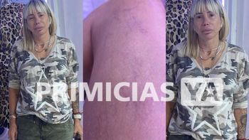 Gabriela Trenchi: Tengo que usar pantalones flojos por los granulomas y los dolores