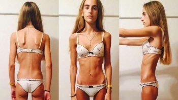 La valentía de Delfina: a los 17 años se animó a compartir su dura lucha contra la anorexia