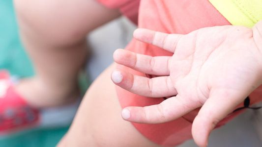 Un niño sufrió quemaduras en el 50% de su cuerpo por manipular botella de alcohol cerca del fuego