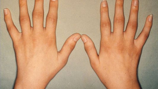 Artrosis en las manos: cómo reconocer los síntomas y qué hacer para aliviar el dolor