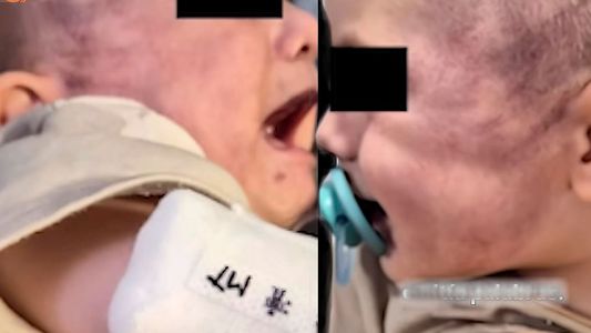 Escándalo y alarma en una guardería: una madre denunció que dejó a su bebé sano y se lo devolvieron brutalmente golpeado