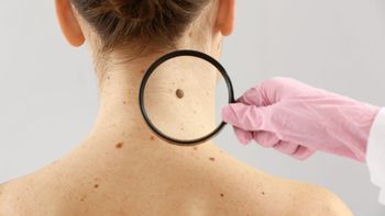 Lunares peligrosos: las señales de alerta que se pueden detectar con un autoexamen