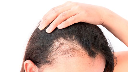 Caía de pelo: evitala con estas vitaminas que encontrás en alimentos