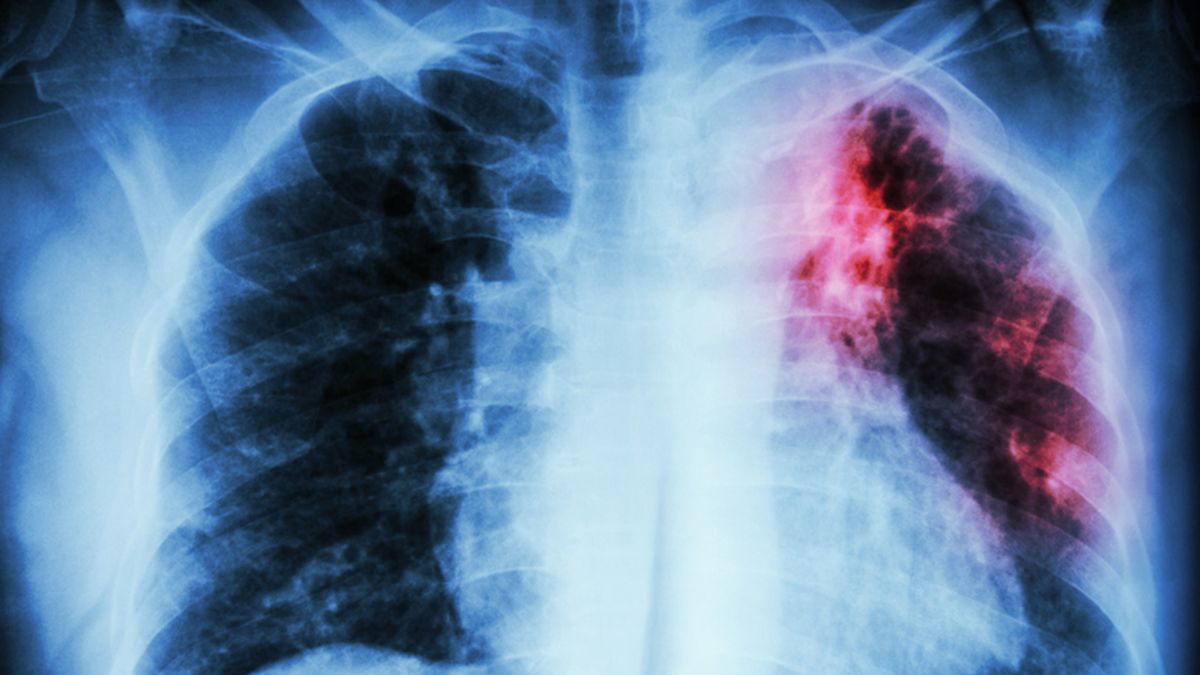 En el macro del Día Mundial de la Tuberculosis  (TB), la provincia de Catamarca dio a conocer un aumento de casos de la enfermedad