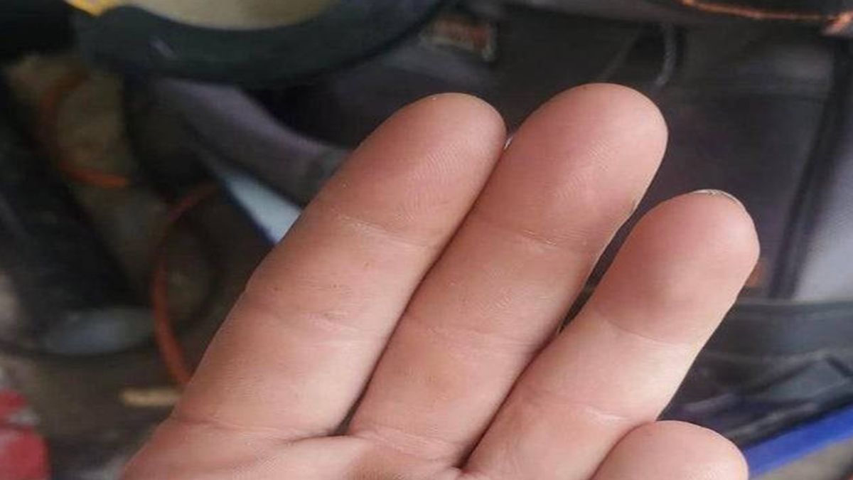 Un joven perdió su dedo en un accidente con una moto sierra y lo encontró seis meses después. 