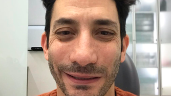 El actor Juan Minujín se operó de la boca en plena cuarentena