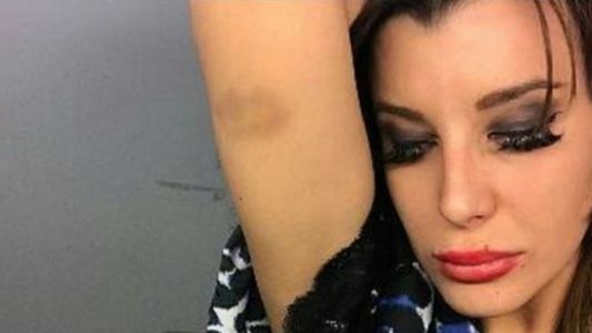 La foto que subió y borró Charlotte Caniggia con un moretón