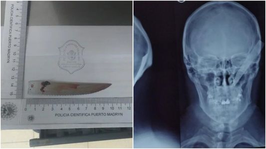 Chubut: Lo atacaron de una forma brutal y decidió perseguirlos con un cuchillo clavado en la cabeza