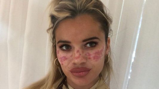 Una modelo se quemó el rostro y perdió la vista por hacer un truco de belleza de TikTok