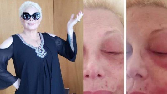 Las impactantes imágenes del rostro de Carmen Barbieri con culebrilla
