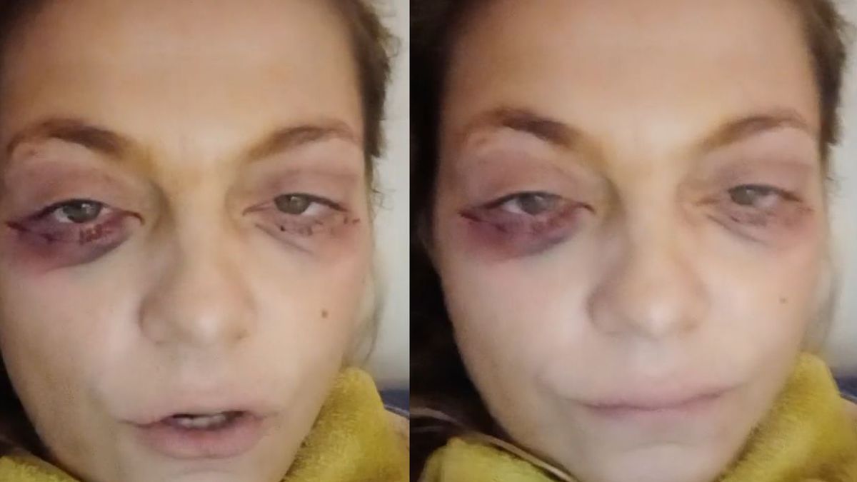 Una ex Gran Hermano apareció con moretones en la cara y preocupó a todos.