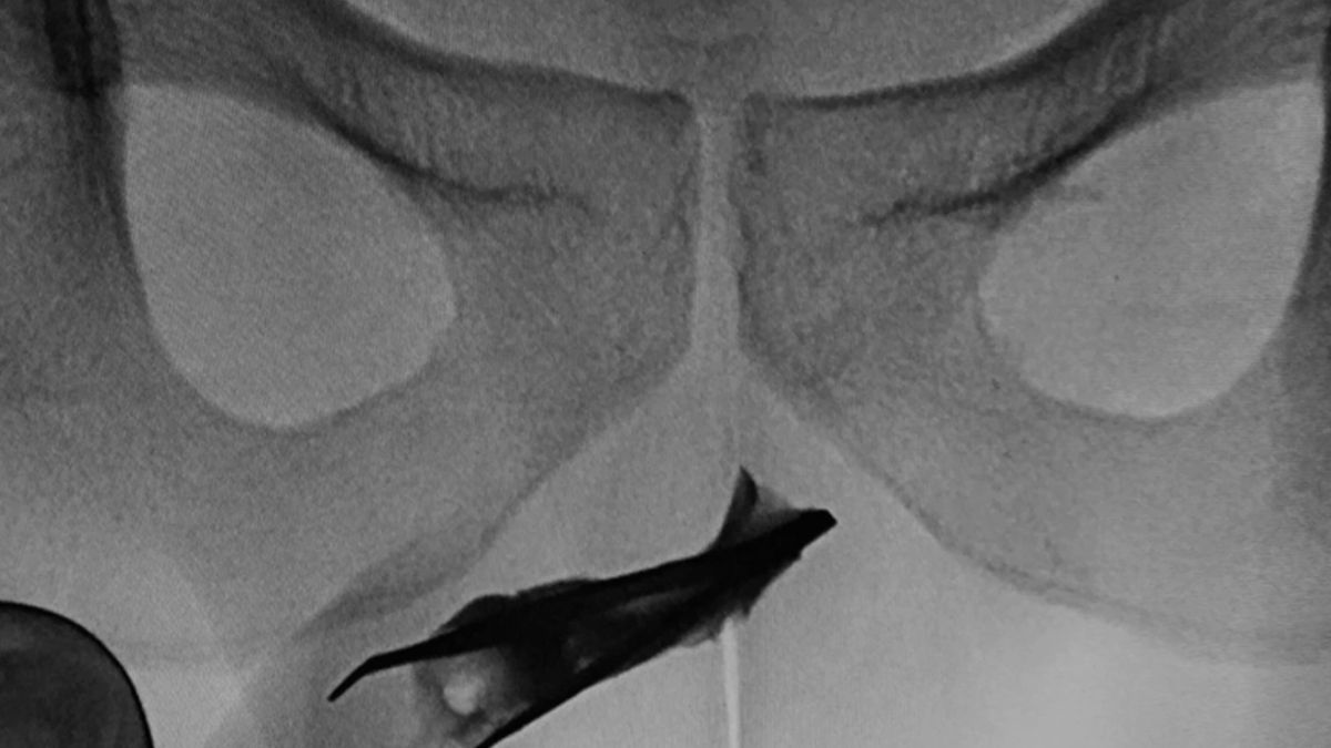 Le quitaron de la uretra una pinza de depilar que se había introducido cuatro años antes.