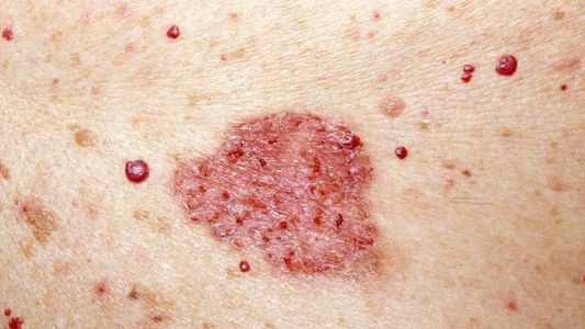 Qué es y cómo prevenir el carcinoma de piel, la enfermedad que tiene Facundo Arana