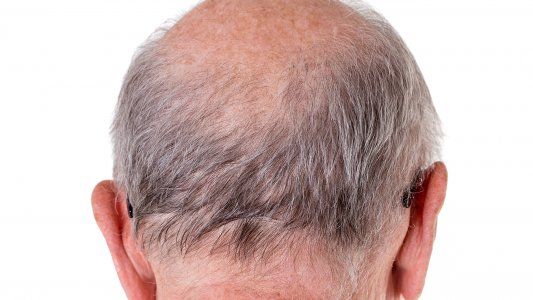 Covid-19: aseguran que los hombres calvos son más propensos a contraer un cuadro más grave