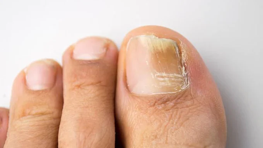 Hongos en las uñas de los pies: cómo prevenir y cuál es el tratamiento más práctico para eliminarlos