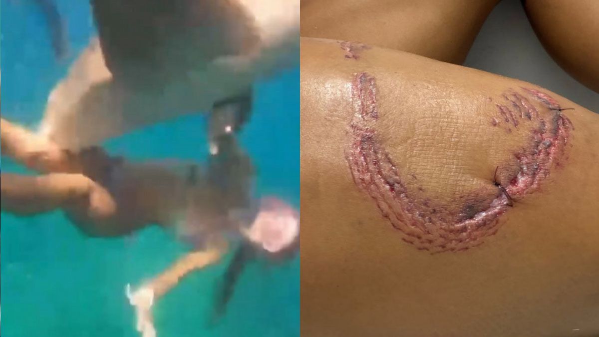 El momento del ataque del tiburón y la herida que le dejó en la pierna de la bañista. (Foto: A24.com)
