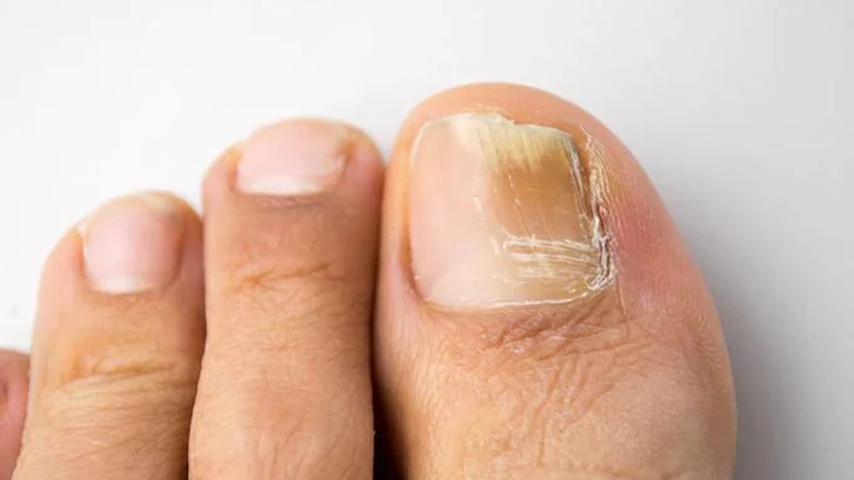 Los&nbsp;hongos en las uñas&nbsp;son una&nbsp;infección común&nbsp;