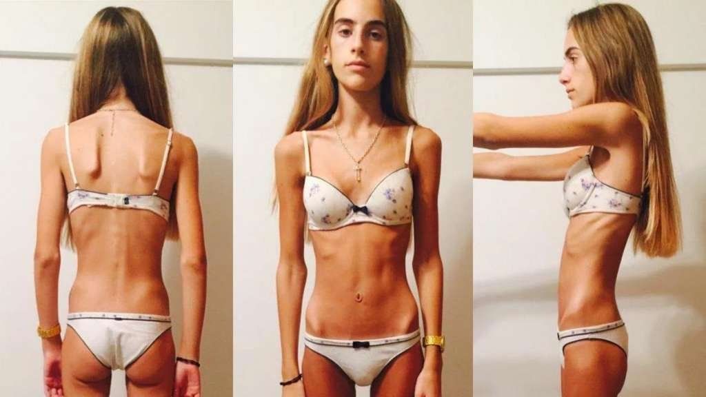 La valentía de Delfina: a los 17 años se animó a compartir su dura lucha contra la anorexia