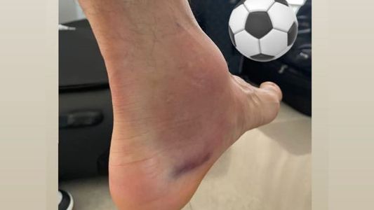 Así quedó el tobillo de la figura de la Selección en la final de la Copa América