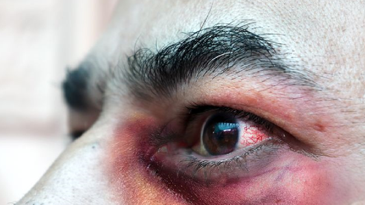 Primer muerto en la Argentina por el hongo negro