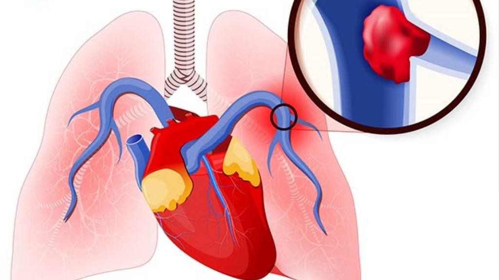 ¿Qué es un tromboembolismo pulmonar, la enfermedad que sufrió Alberto Fernández?