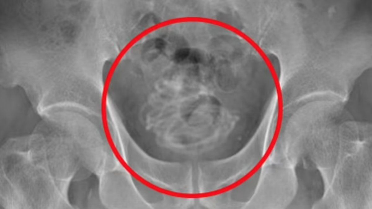 Una tomografía mostró la presencia del objeto en la vejiga del anciano (Foto: Daily Mail).