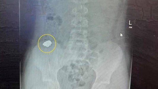 Un joven ingirió más de 50 imanes para volverse magnético: debieron operarlo de urgencia