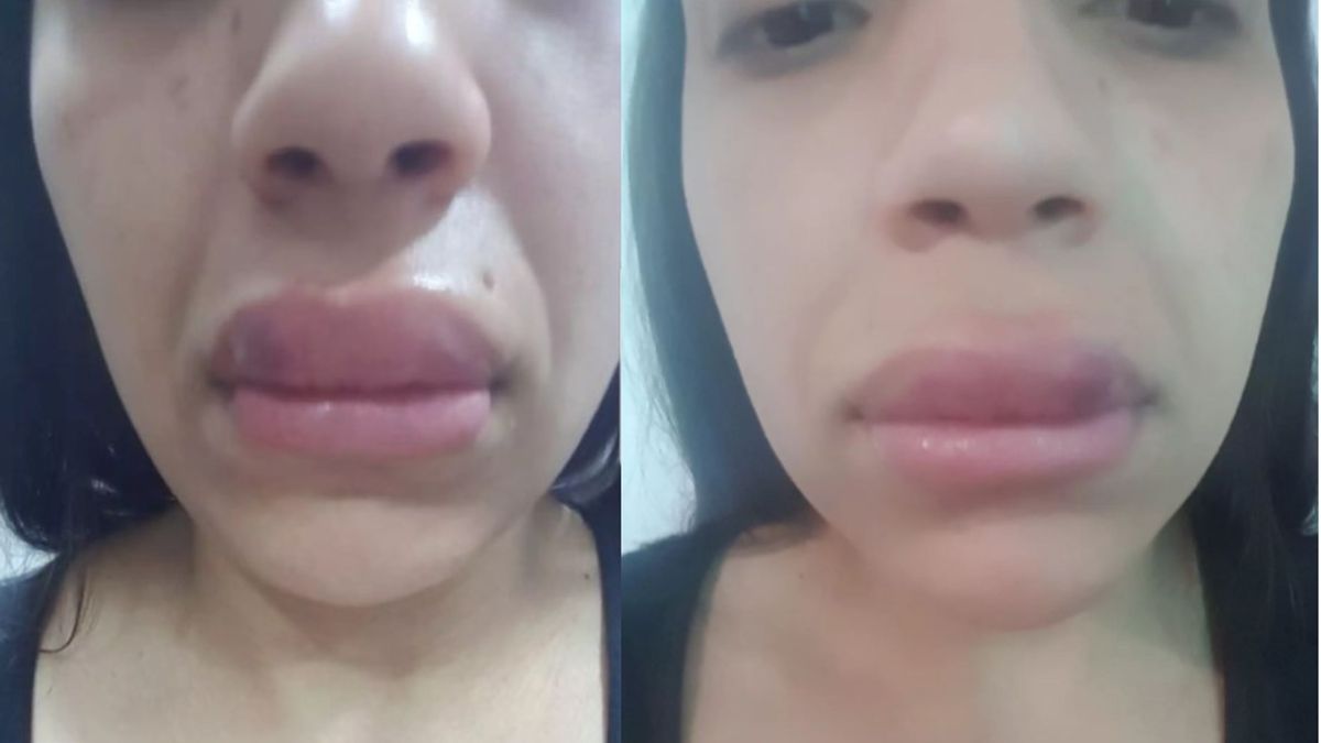 Nadia Walezuk contó toda la pesadilla que le tocó vivir cuando fue a un centro de estética. (Foto: Instagram: @nadiawalezuk)