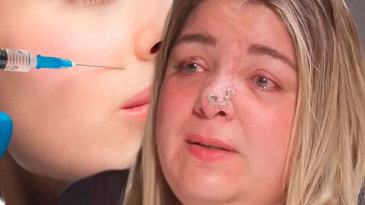 Daniela Quintana mostró las terribles consecuencias que sufrió luego de usar ácido hialurónico: No veo