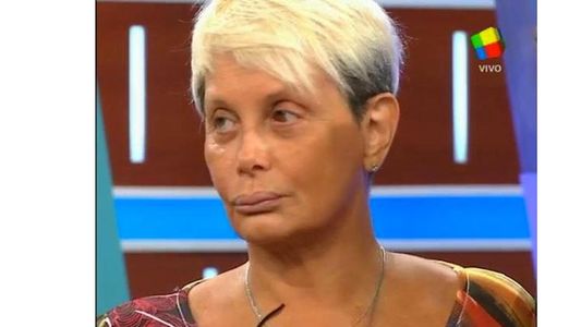 Carmen Barbieri reapareció en televisión con un “ojo explotado”