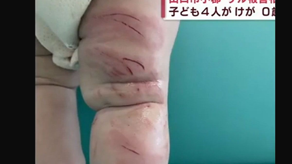la pierna lastimada de la bebé atacada por un mono en Japón ( Foto: Gentileza Daily Mail)