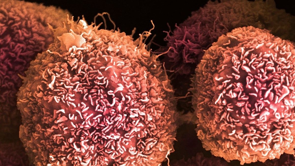 Micrografía electrónica coloreada de células de cáncer de páncreas en una fase temprana. Foto Anne Weston / Francis Crick Institute / New York Times Imagen: 1/6