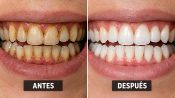 Ni vinagre ni bicarbonato: este es el mejor MÉTODO para eliminar el sarro de los dientes y dejarlos con BRILLO
