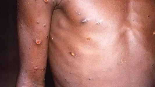 Avanza la viruela del mono en Europa: todo lo que se sabe sobre los inusuales brotes detectados