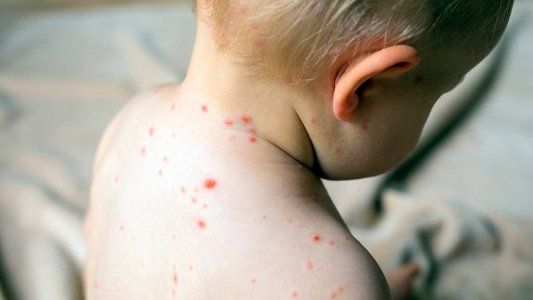 Alerta por sarampión: ya son 55 los casos en la Argentina