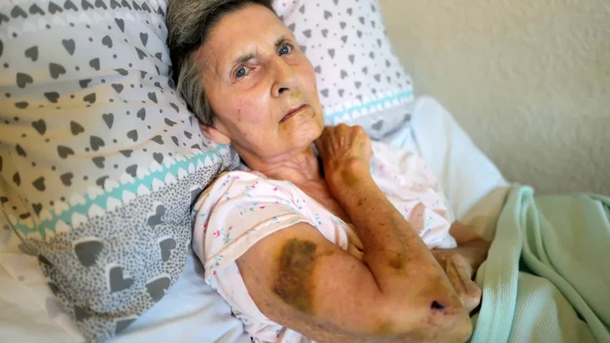 Así quedó la mujer de 76 años tras ser atacada por una rata de 22 centímetros (Foto: Twitter).